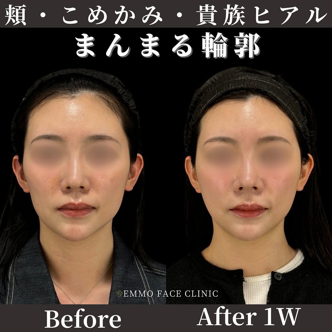 輪郭ヒアルロン酸