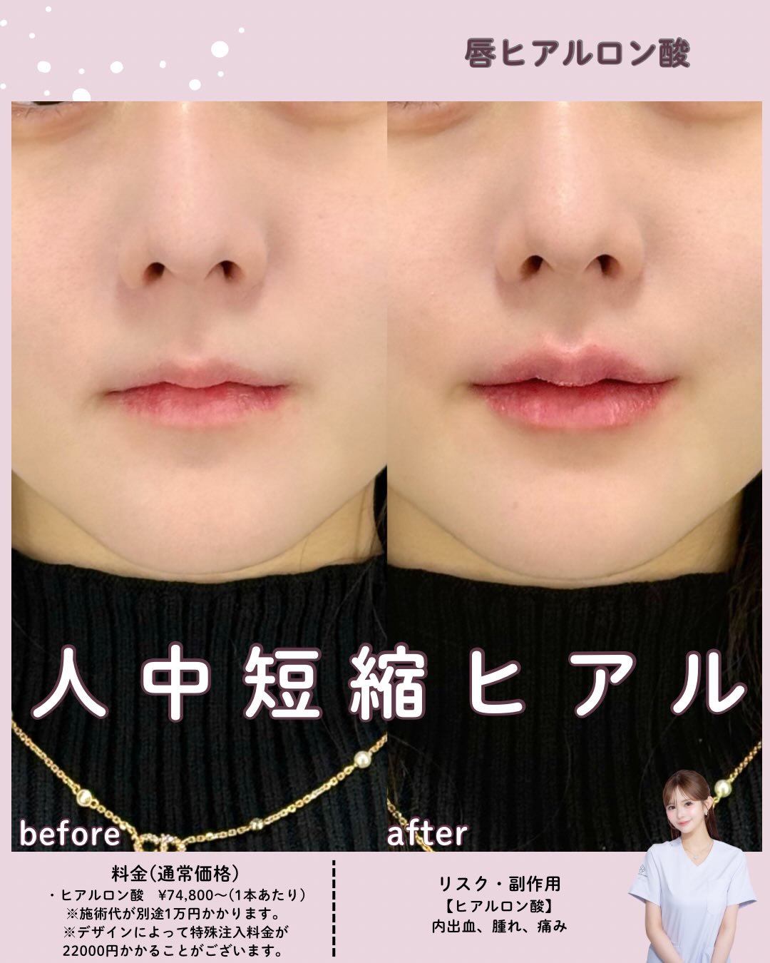 唇 ヒアルロン 酸