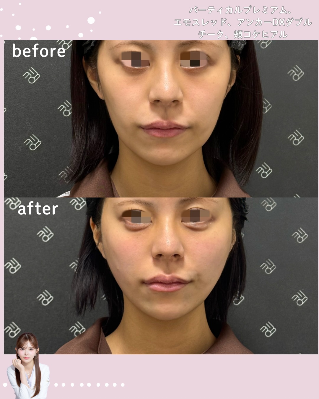 糸リフト×ヒアルロン酸