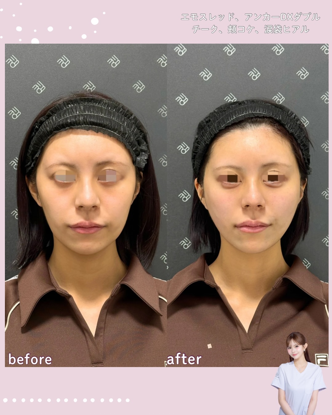 糸リフト×ヒアルロン酸