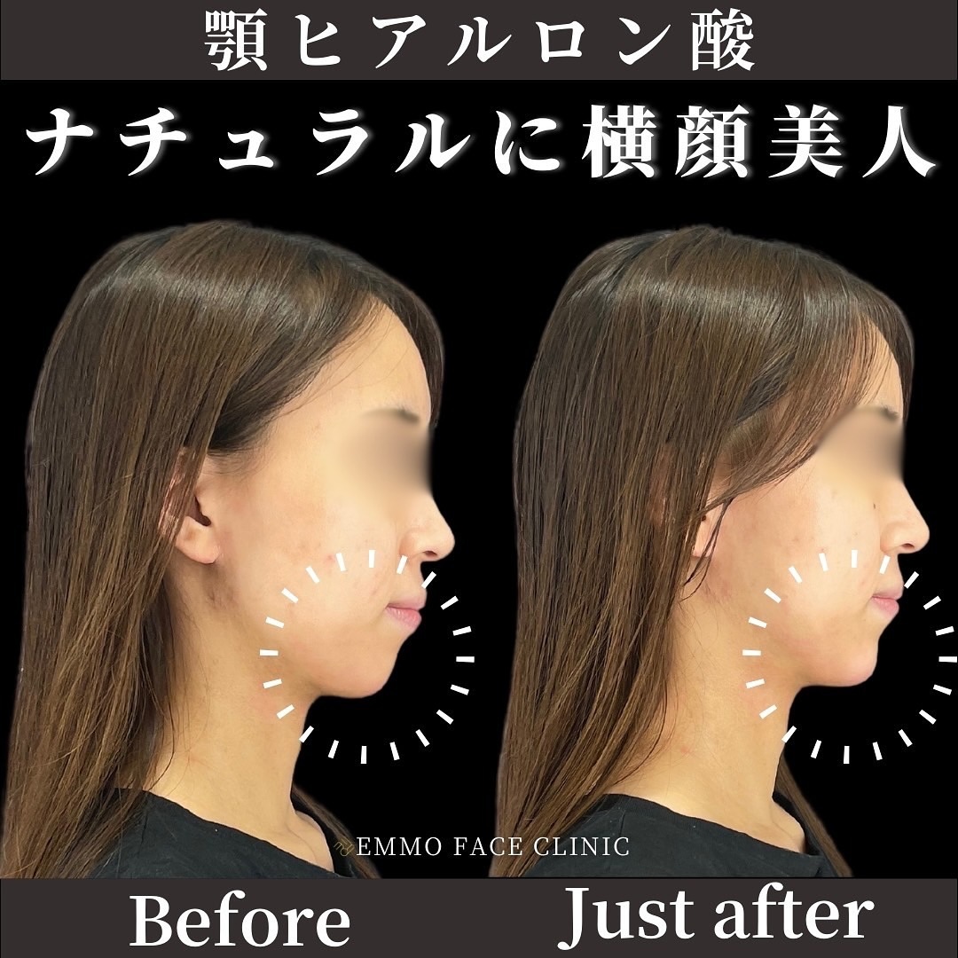ヒアルロン酸(顎)