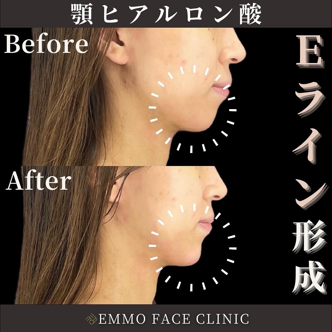 ヒアルロン酸(顎)