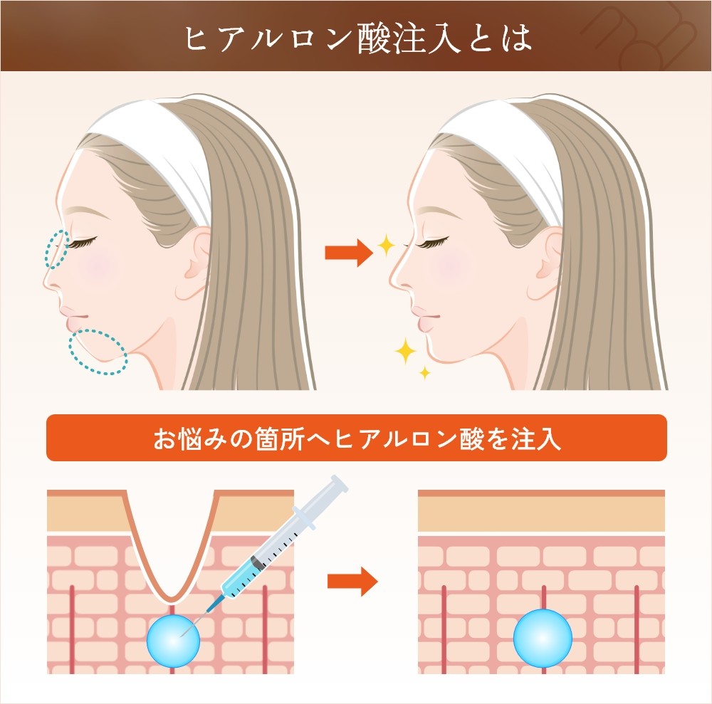 ヒアルロン酸注入