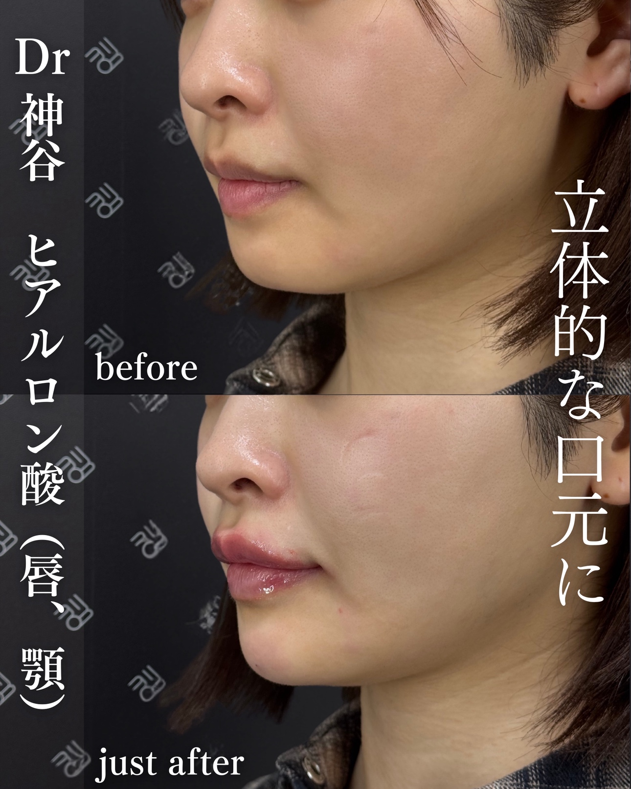 唇ヒアルロン酸ー症例写真