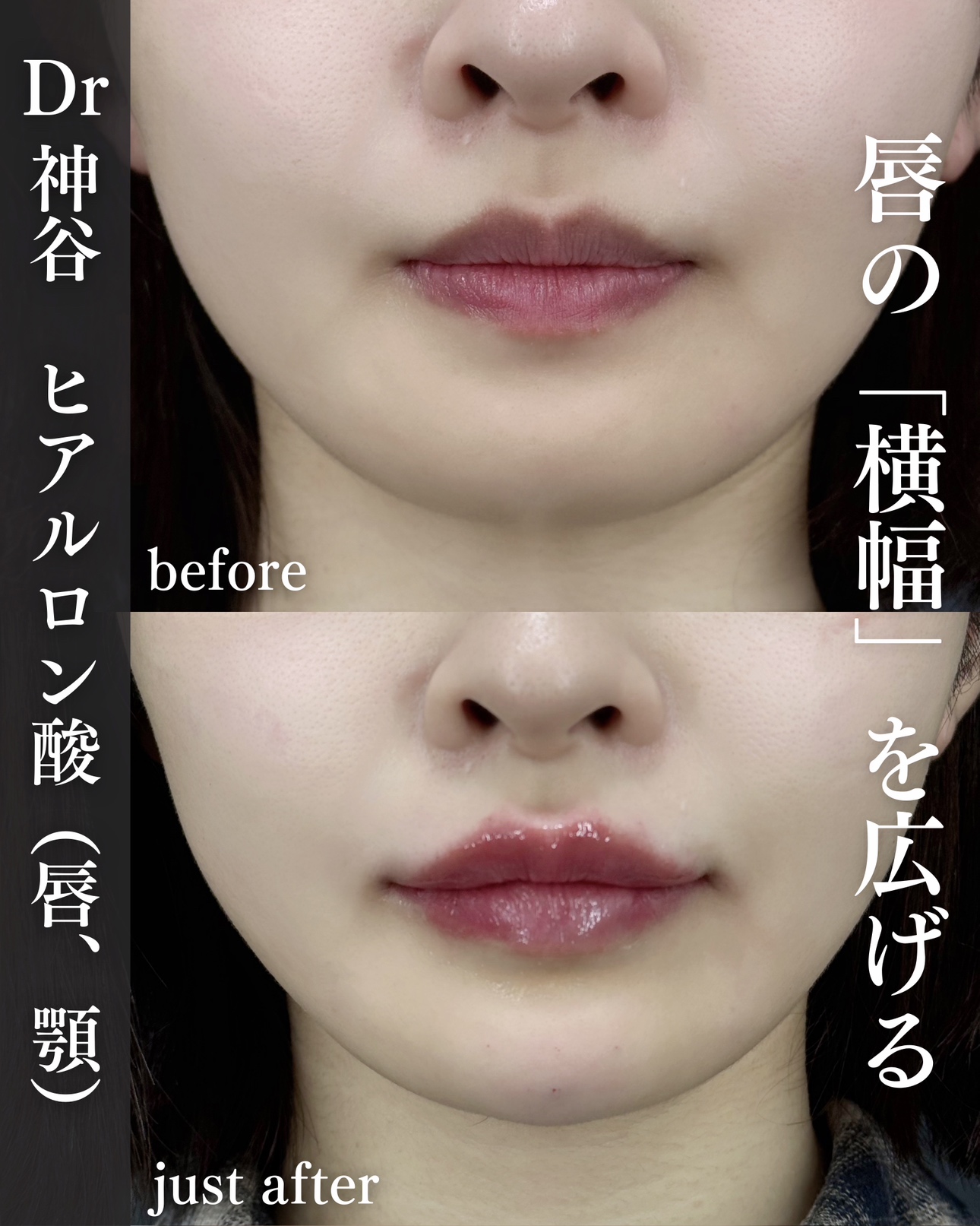 唇ヒアルロン酸ー症例写真