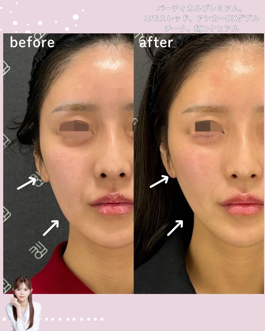 バーティカルリフト×糸リフト×ヒアルロン酸