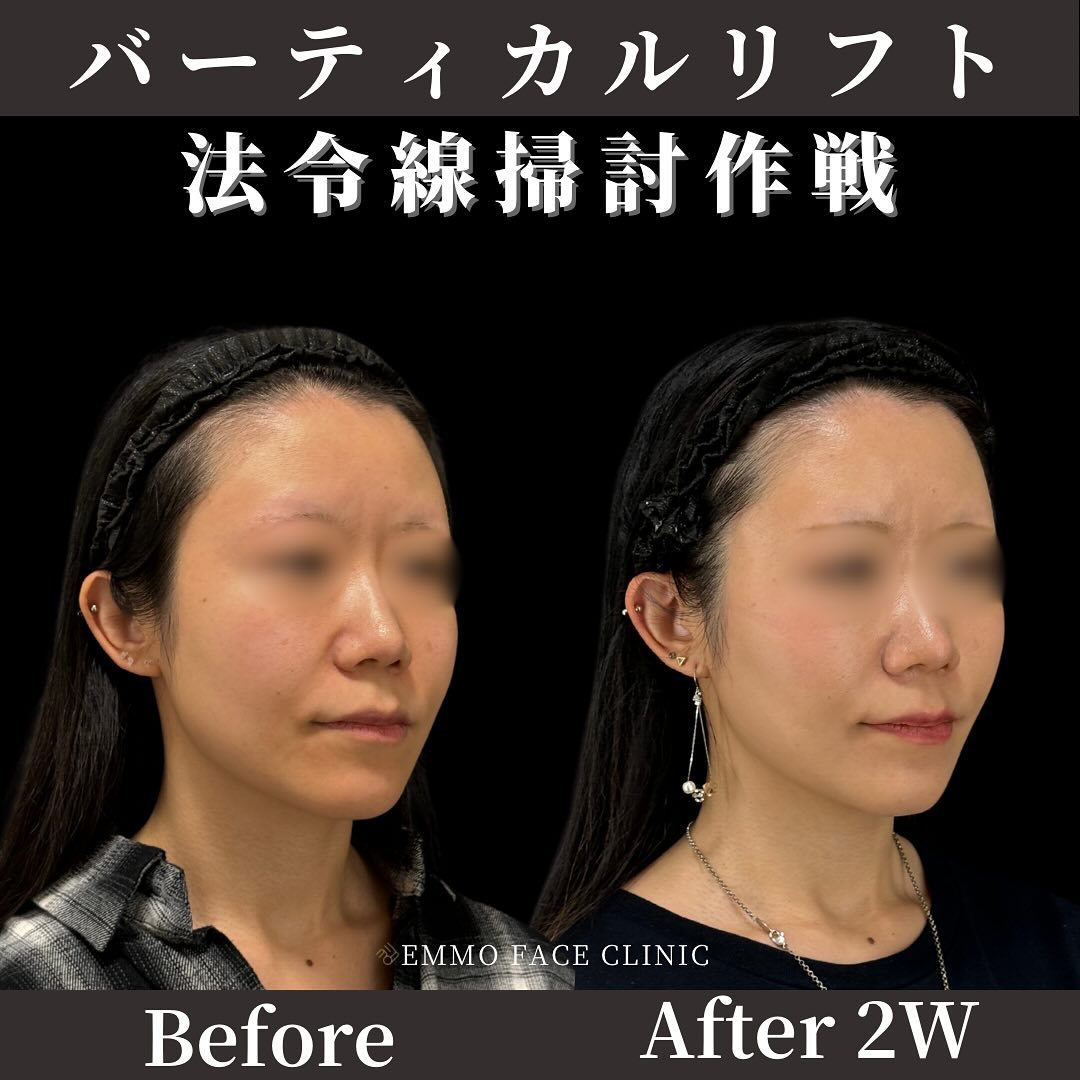 バーティカルリフト