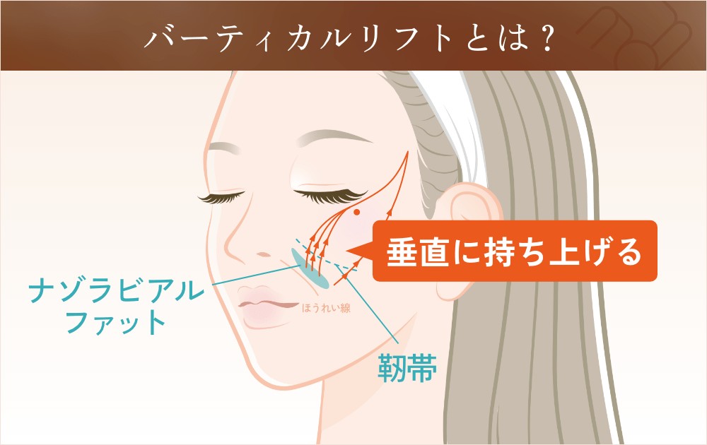 バーティカルリフトとは