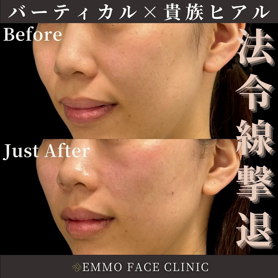 バーティカルリフト×貴族ヒアルロン酸