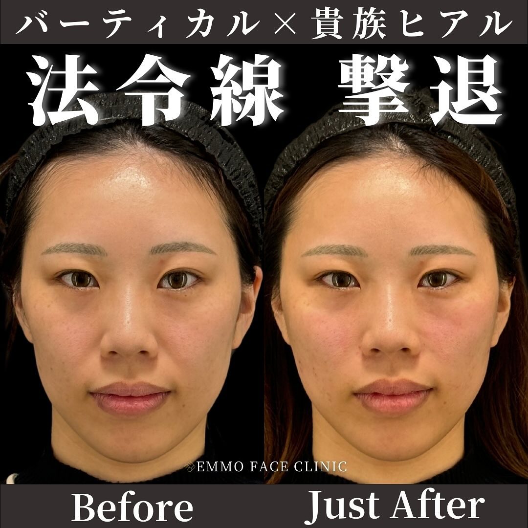 バーティカルリフト×貴族ヒアルロン酸