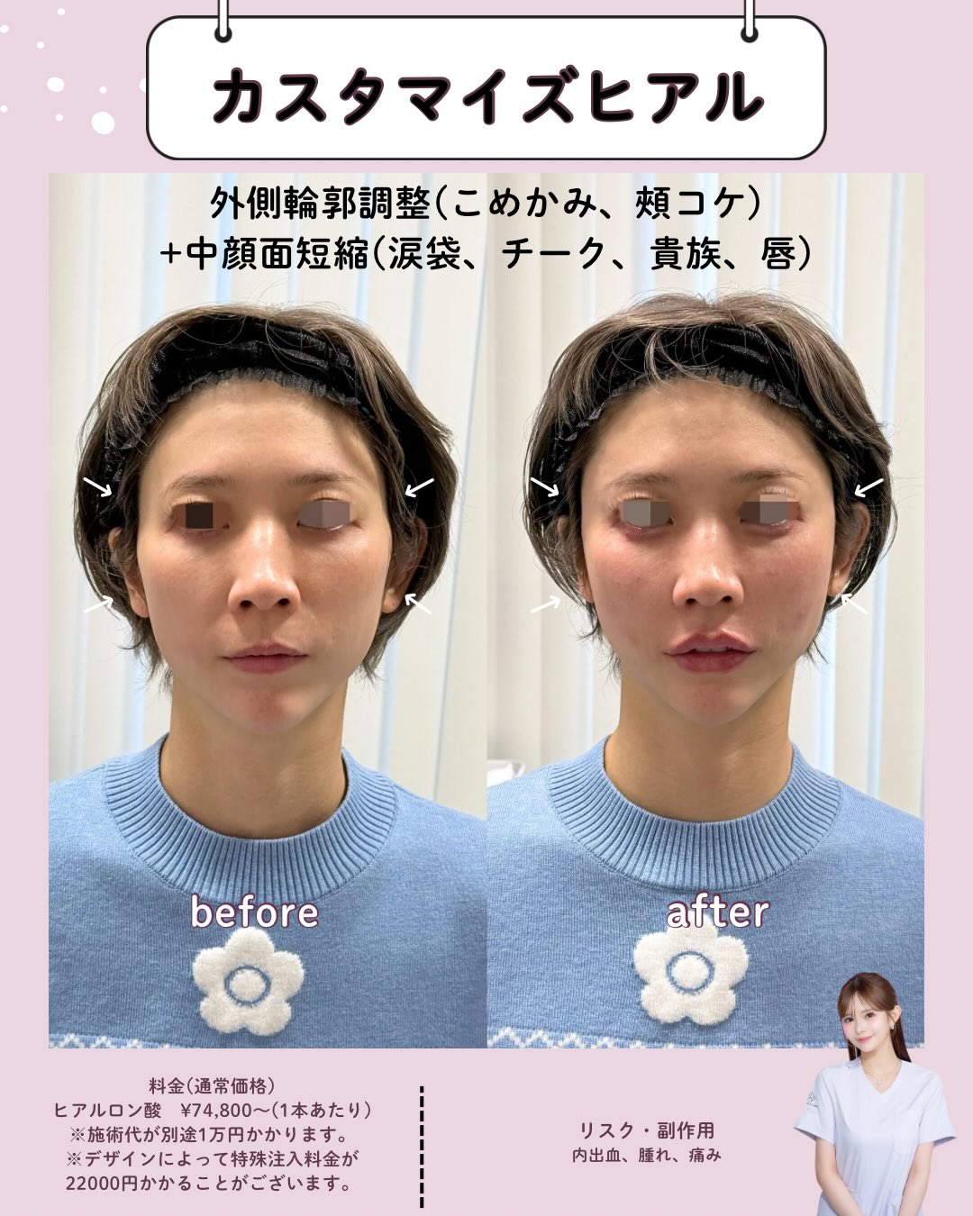 カスタマイズヒアルロン酸