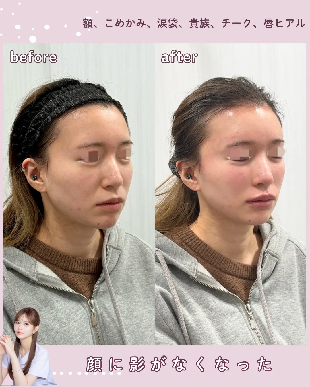 カスタマイズヒアル