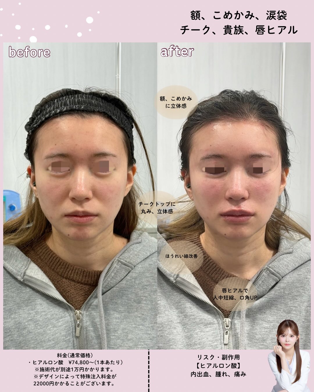 カスタマイズヒアル