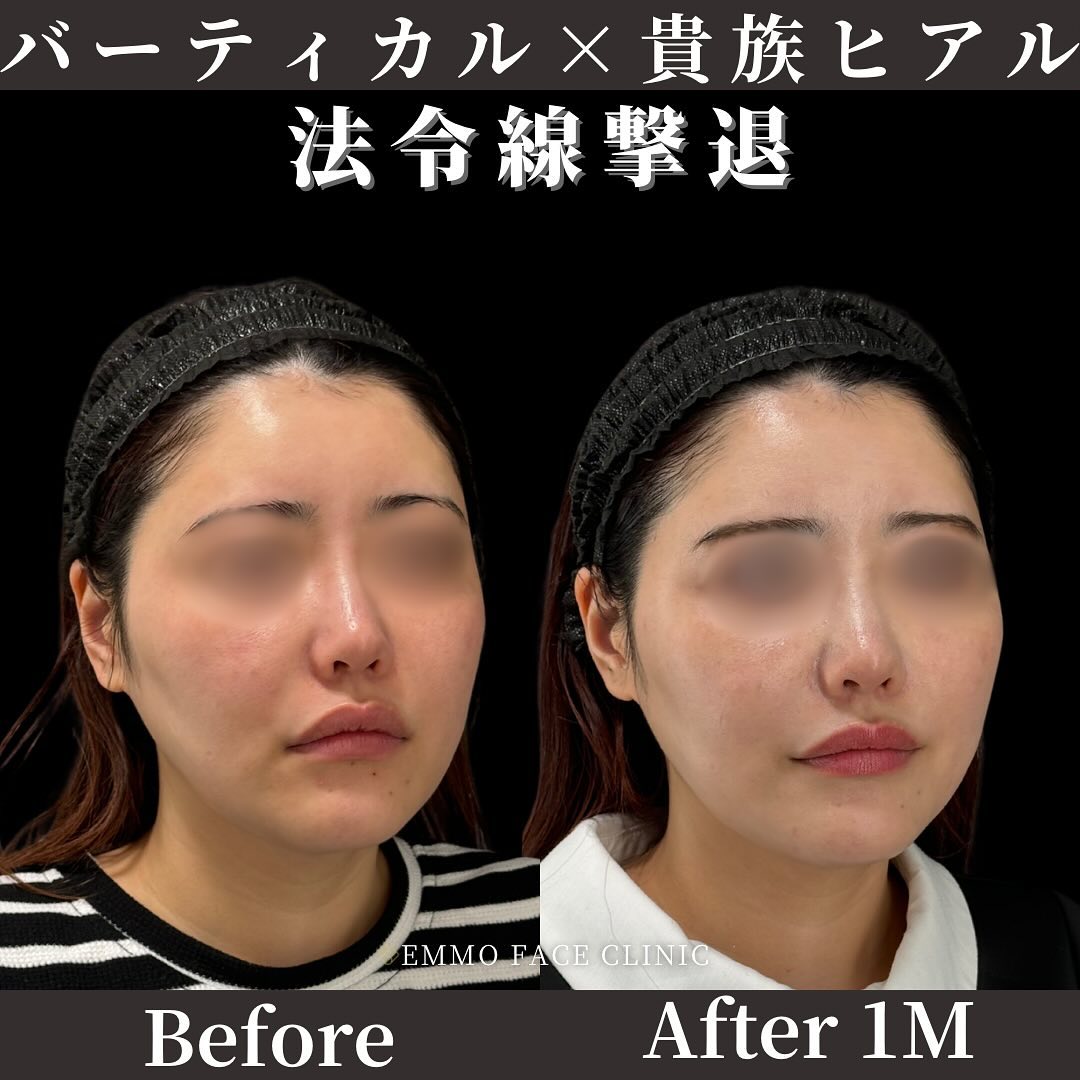 バーティカルリフト×貴族ヒアルロン酸