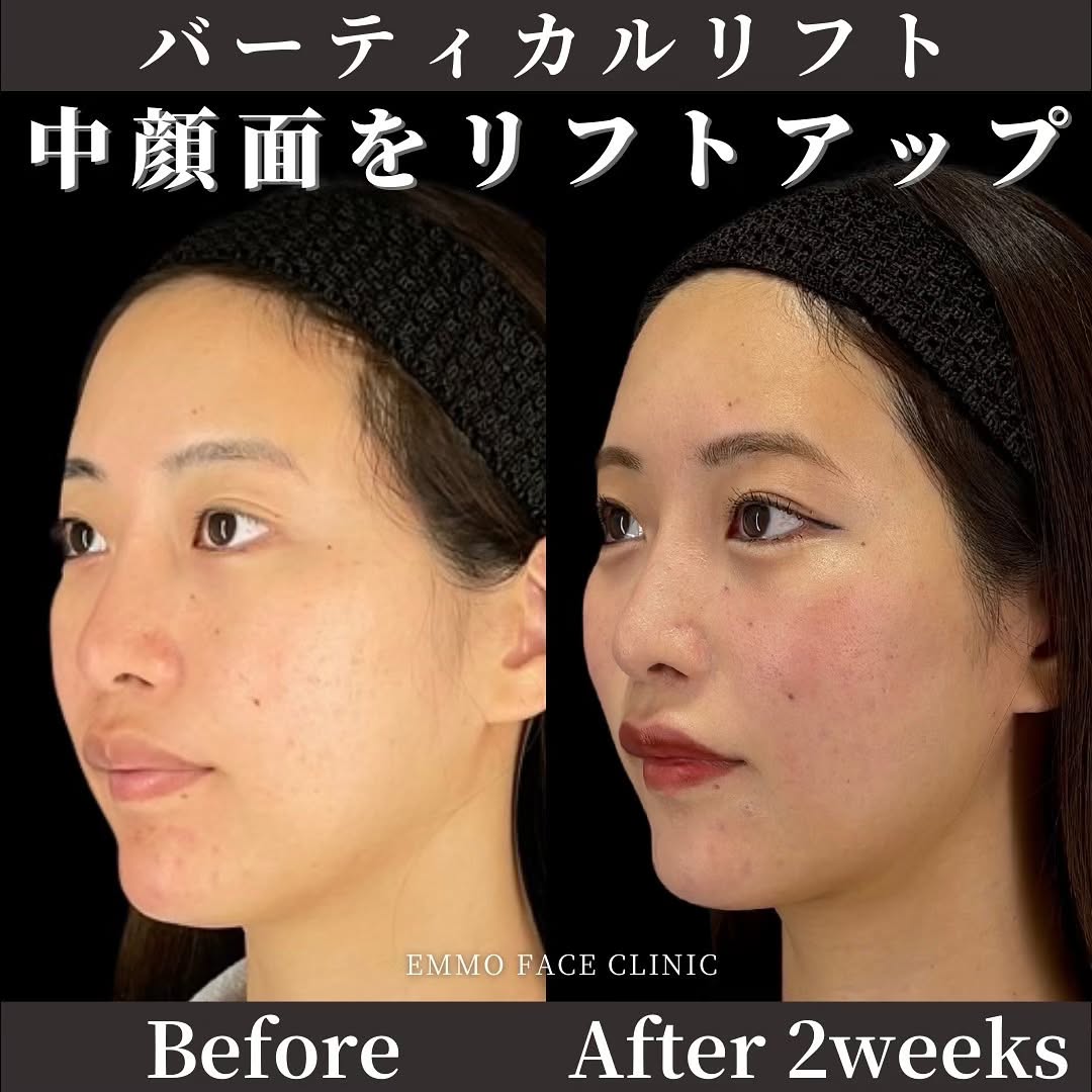 バーティカルリフト