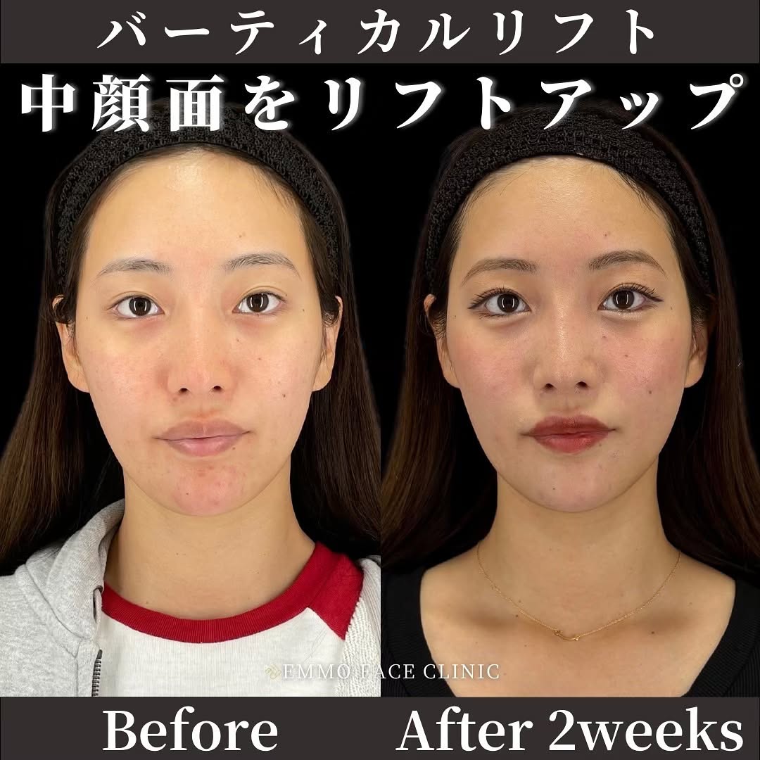 バーティカルリフト