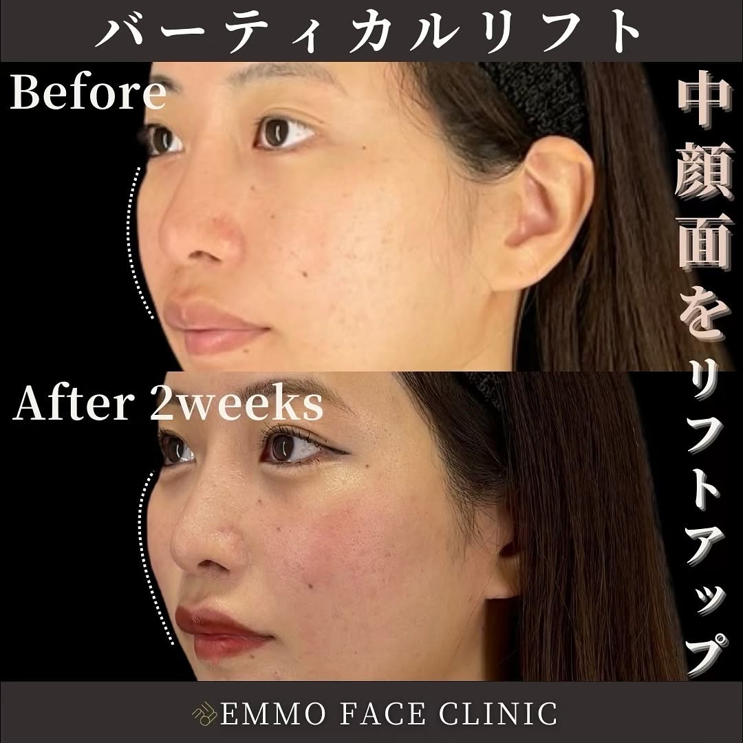 バーティカルリフト