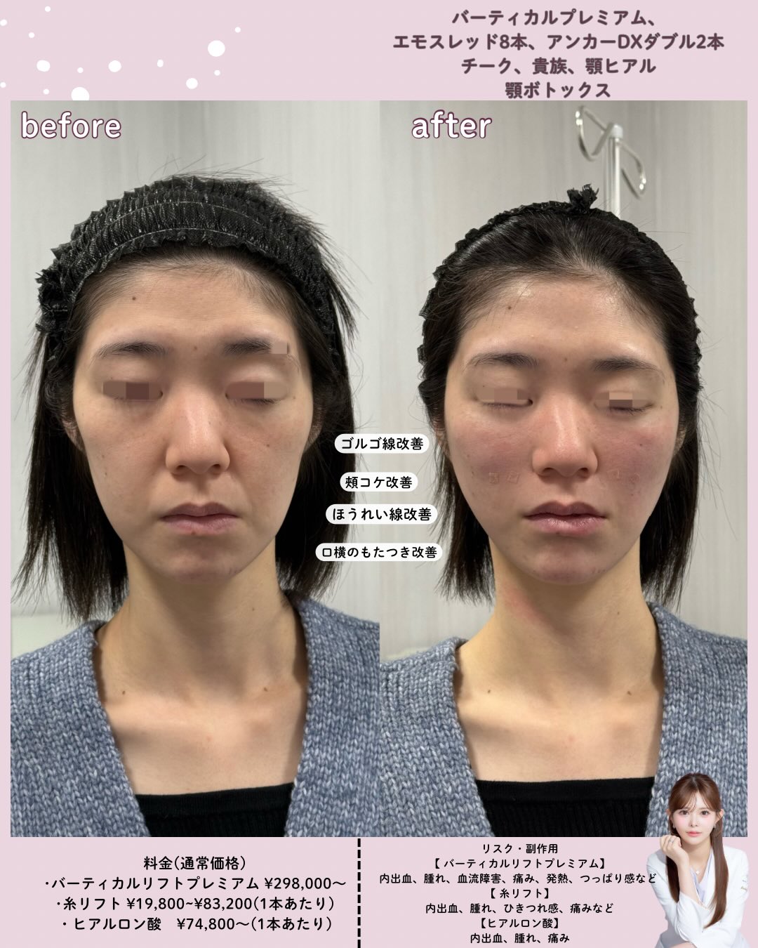 バーティカルリフトプレミアム