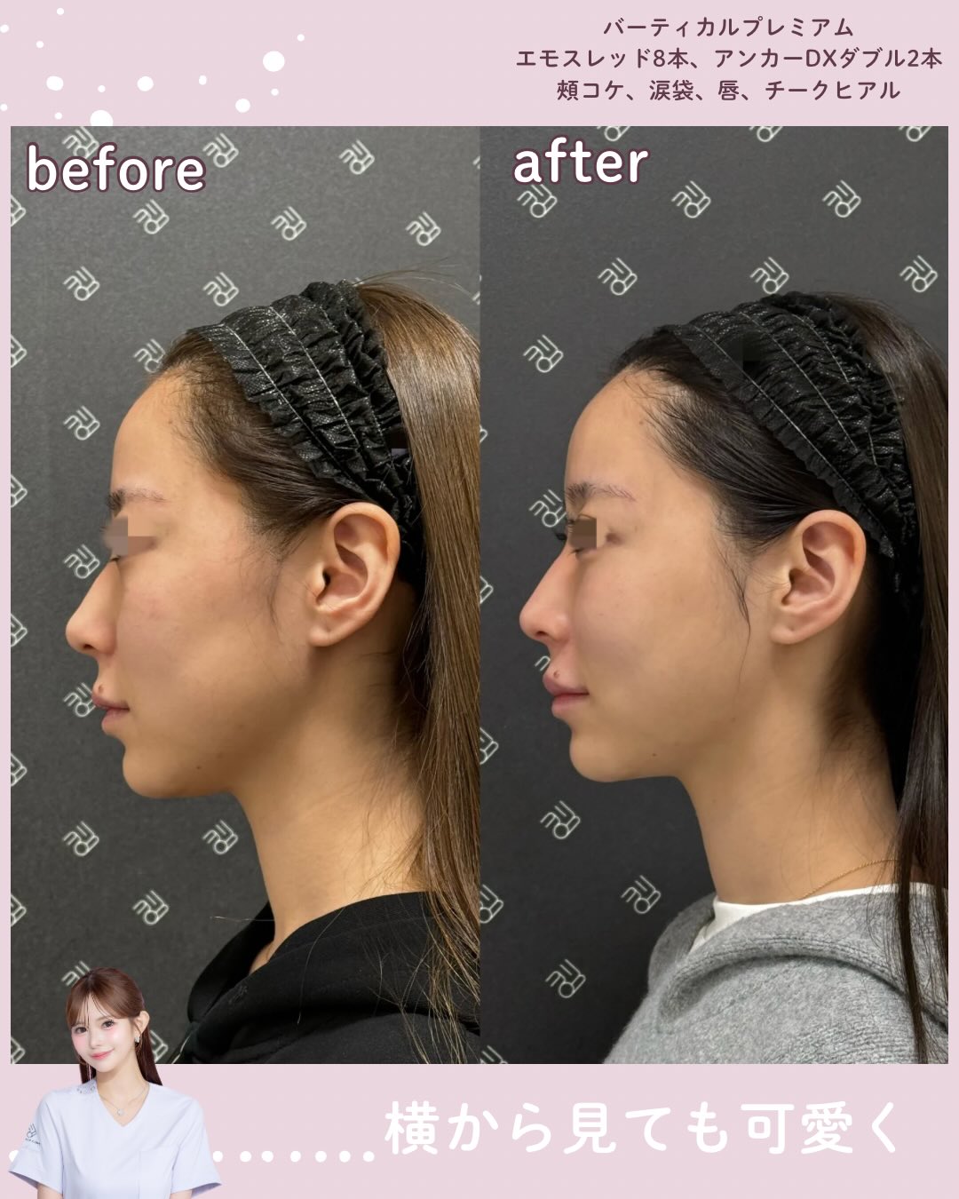 バーティカルリフトプレミアム×糸リフト×ドールヒアル