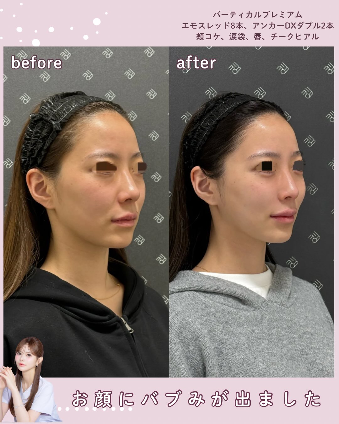 バーティカルリフトプレミアム×糸リフト×ドールヒアル