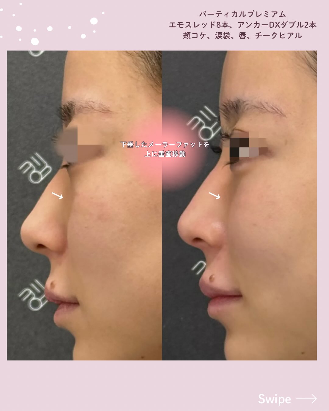 バーティカルリフトプレミアム×糸リフト×ドールヒアル