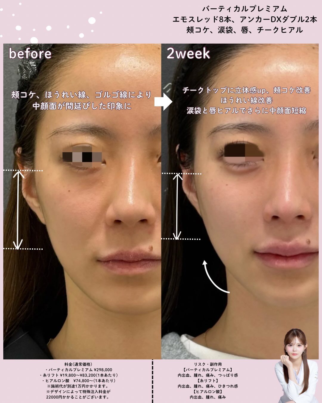 バーティカルリフトプレミアム×糸リフト×ドールヒアル