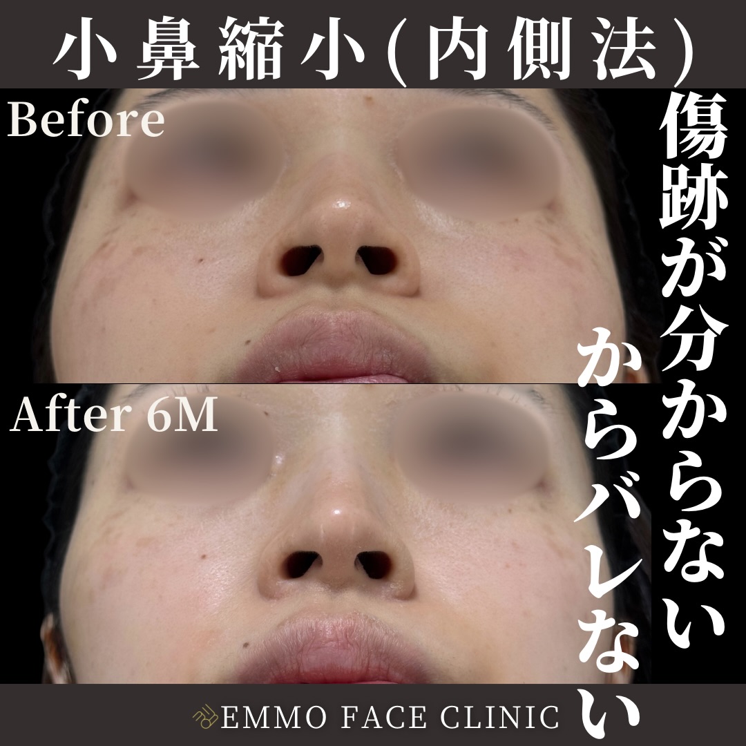 小鼻縮小