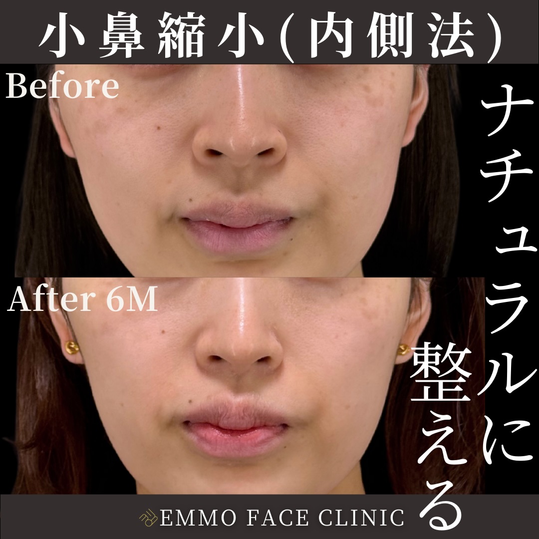 小鼻縮小