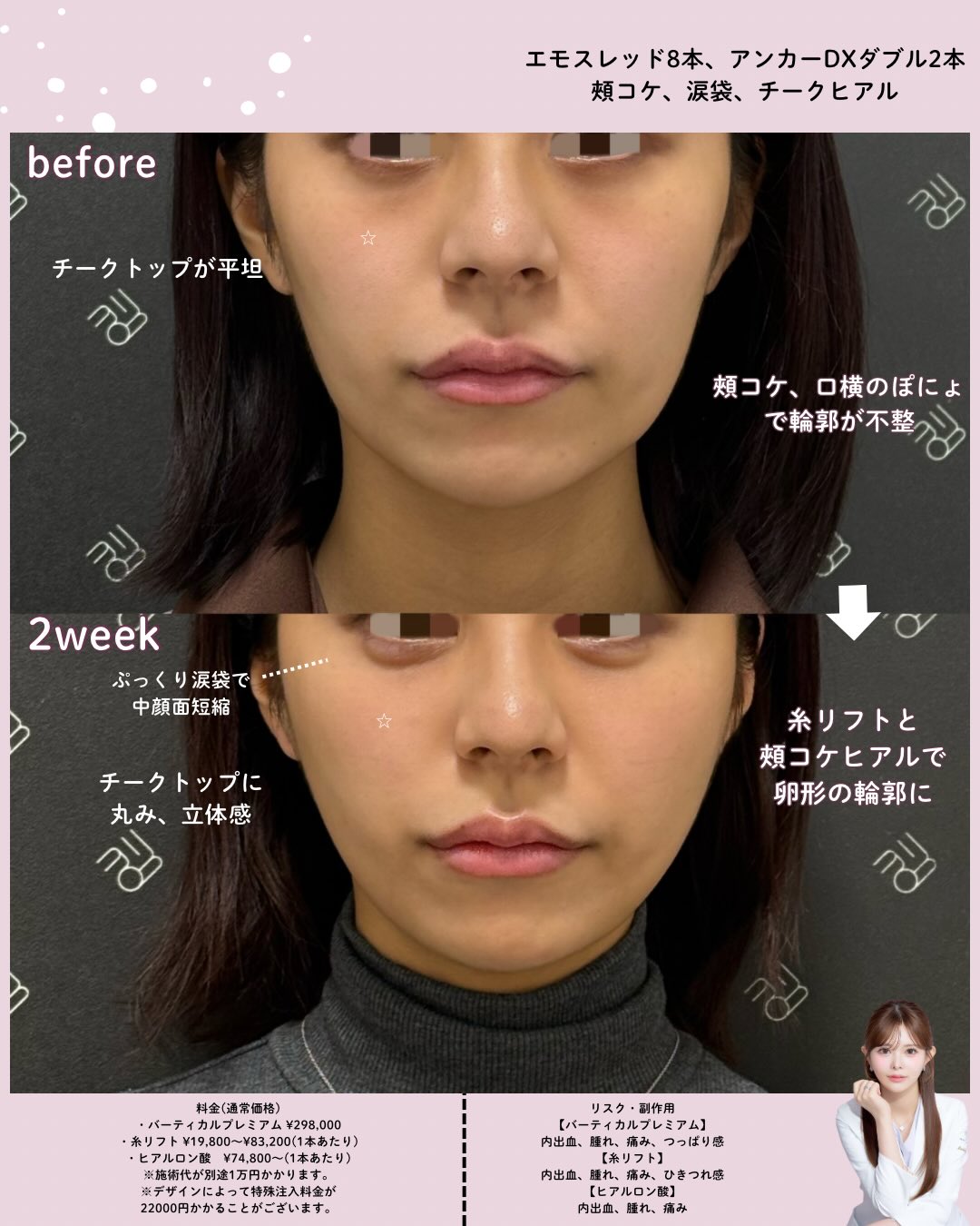 糸リフト×ドールヒアル