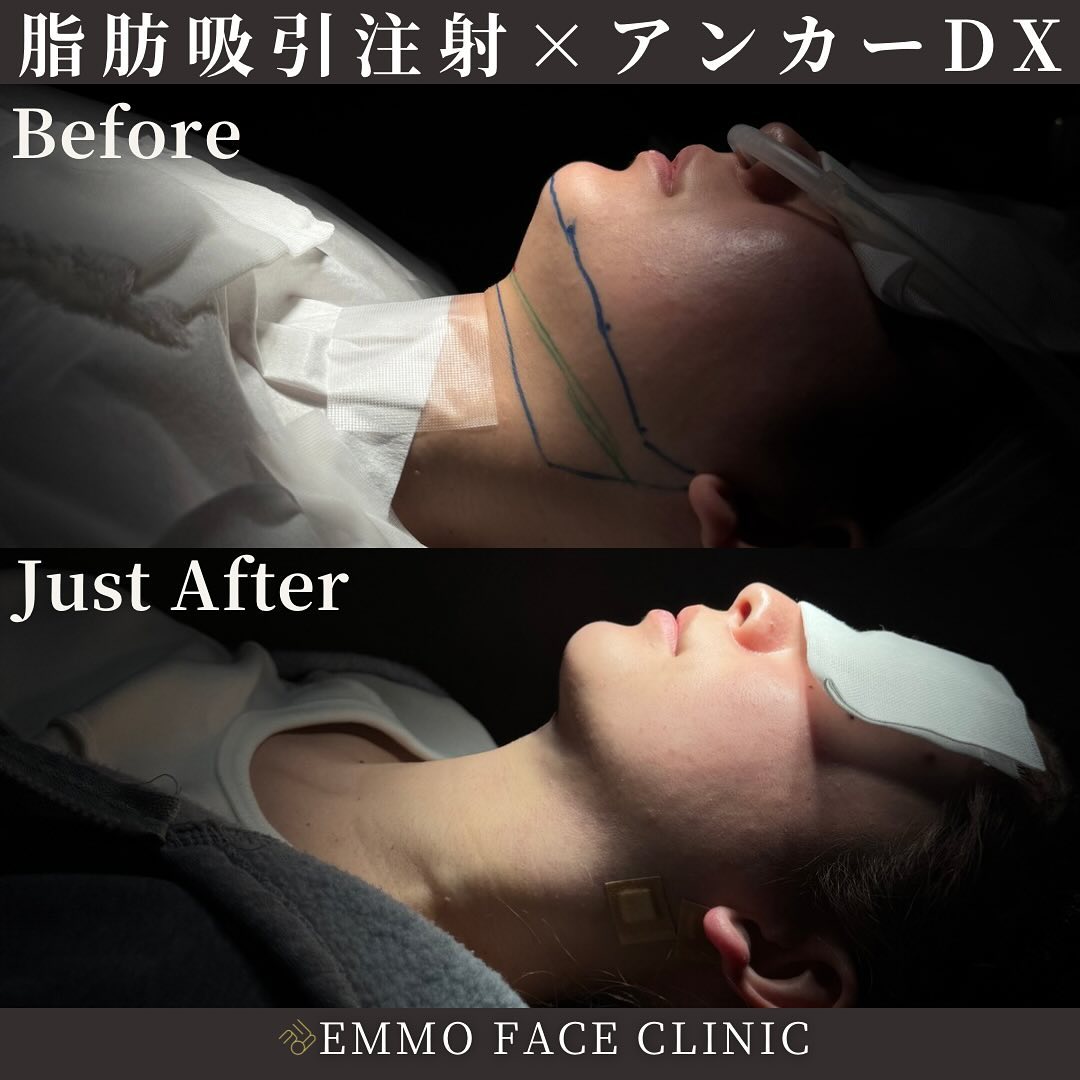 脂肪吸引注射