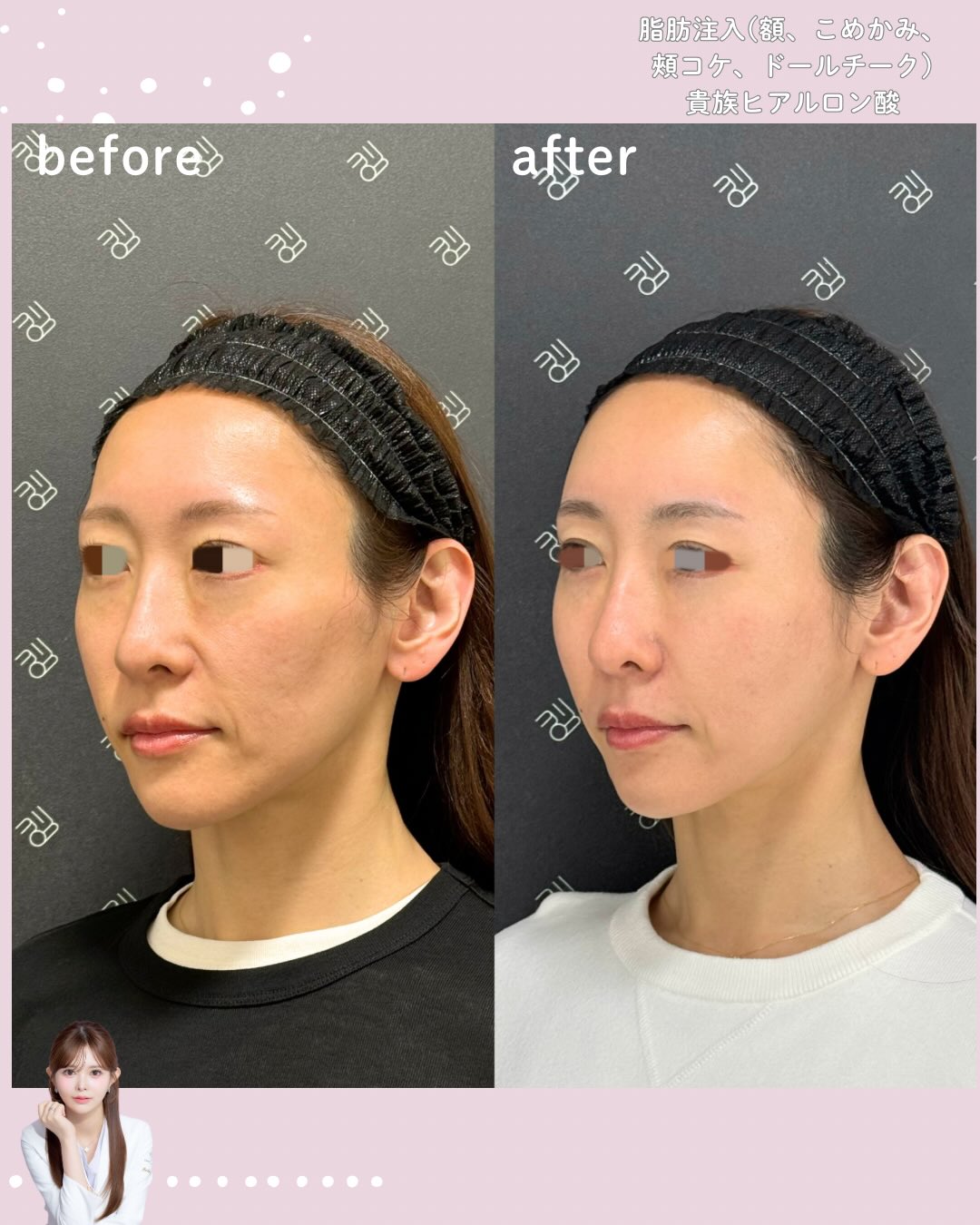 脂肪注入×ヒアルロン酸