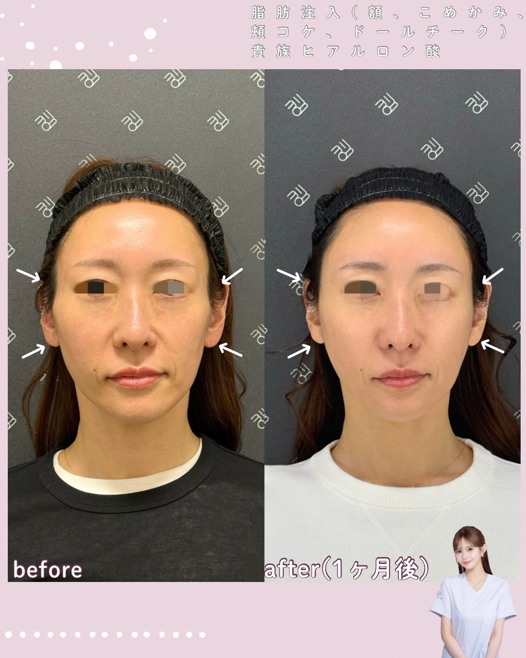 脂肪注入×ヒアルロン酸