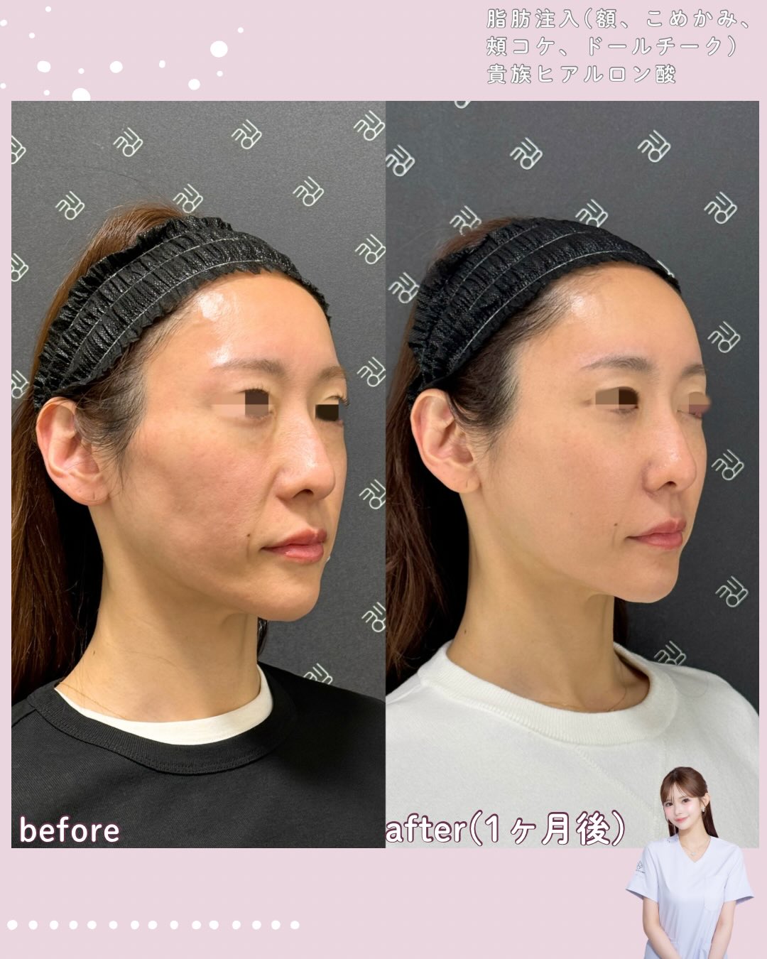 脂肪注入×ヒアルロン酸