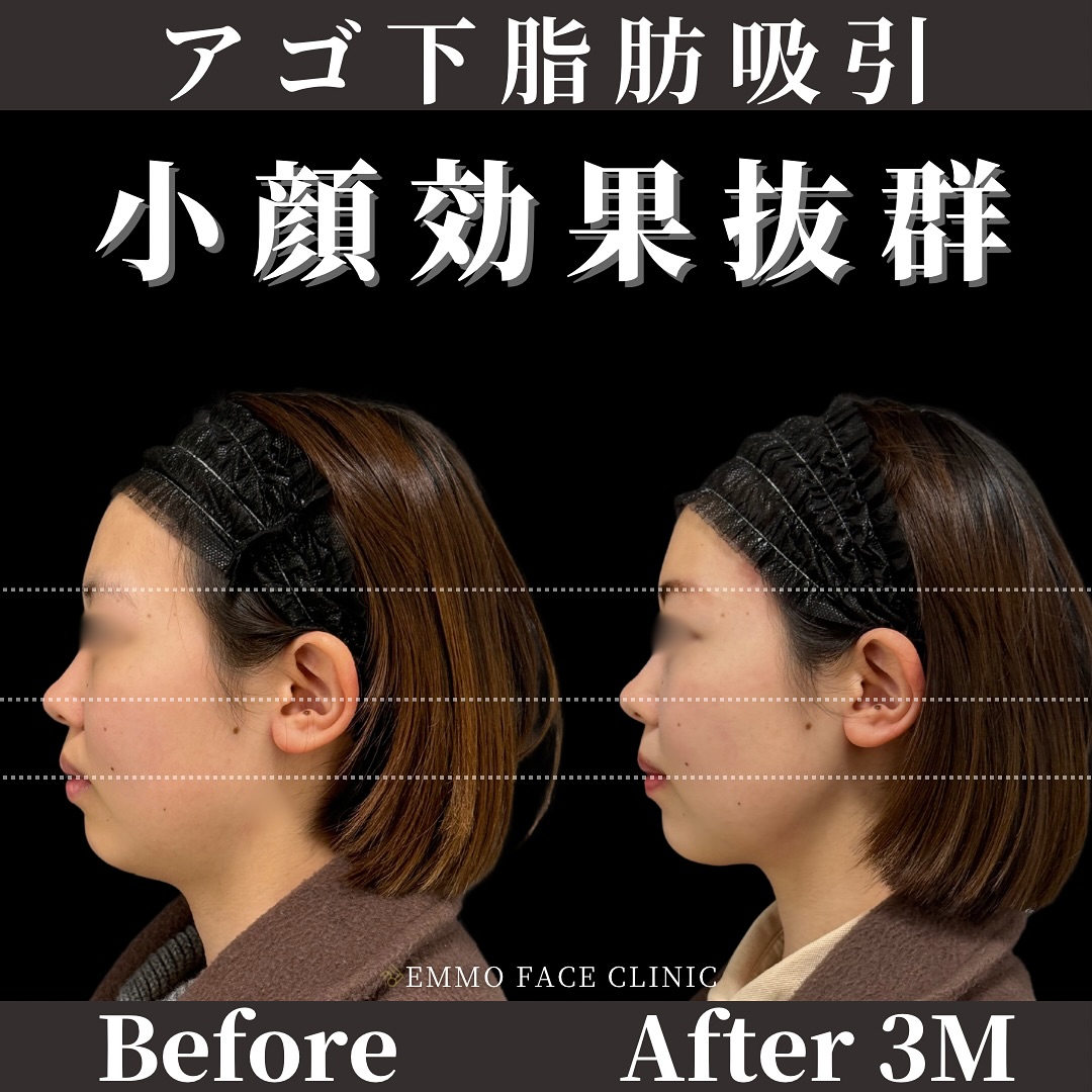 顎下脂肪吸引