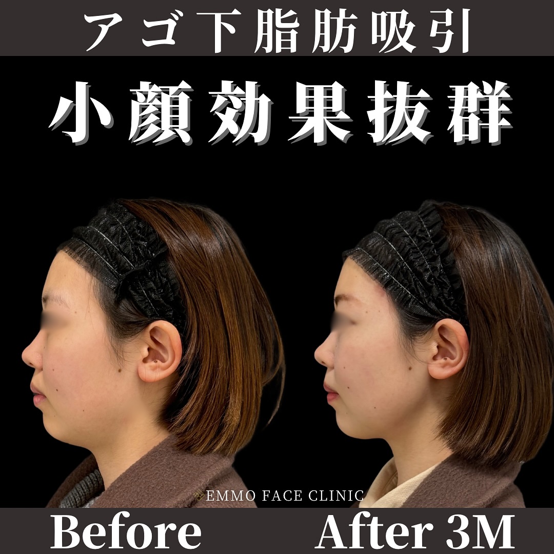 顎下脂肪吸引