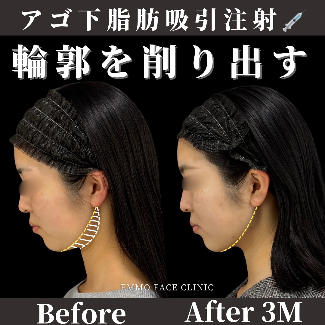 顎下脂肪吸引