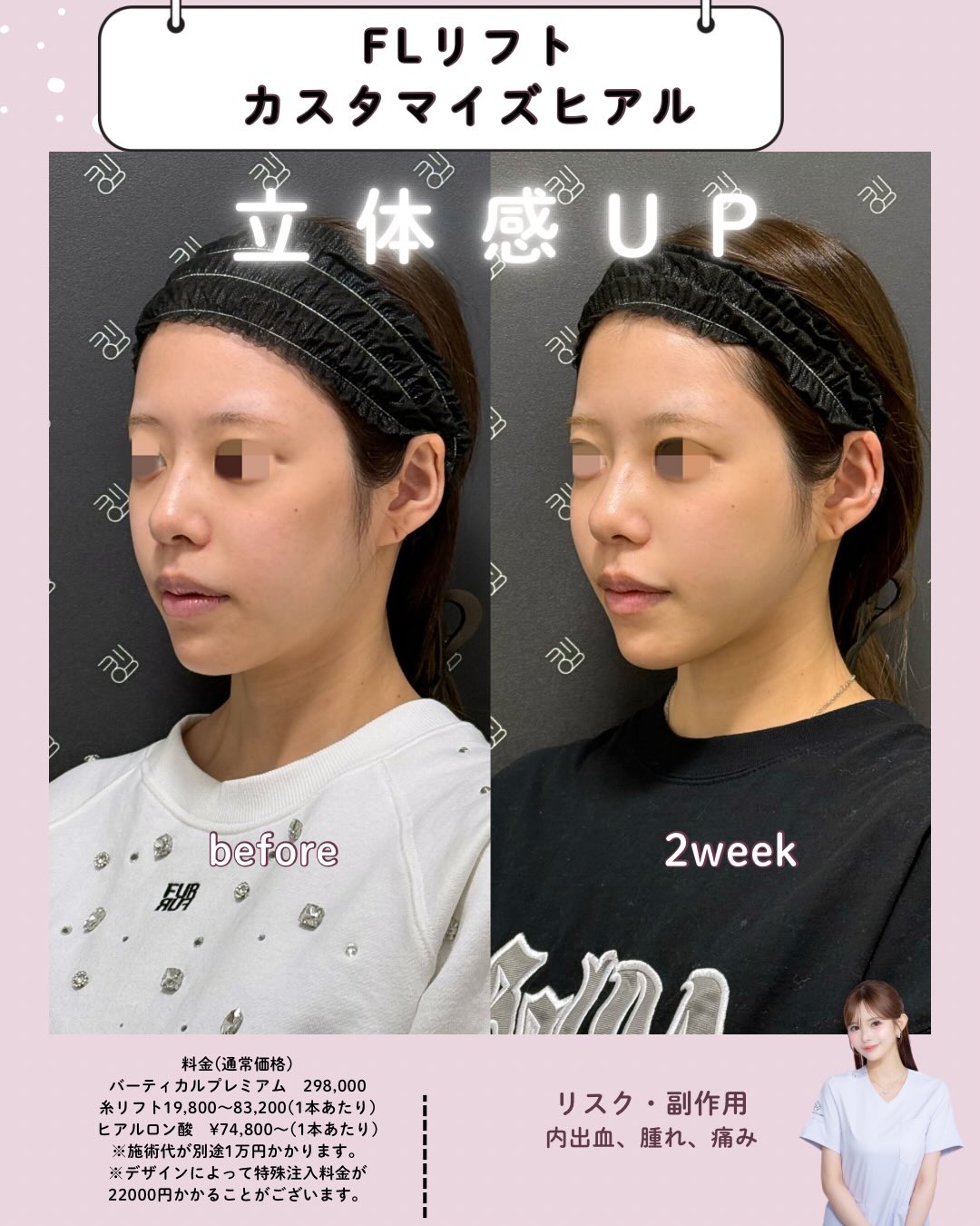 フェイスリフト