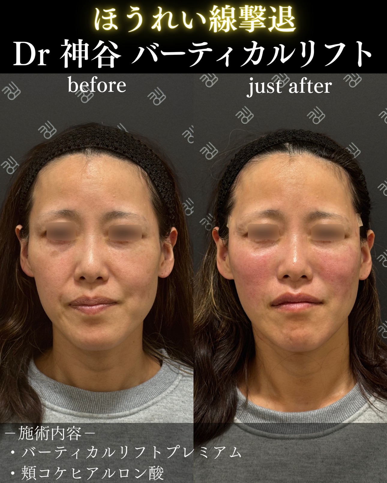 バーティカルリフト