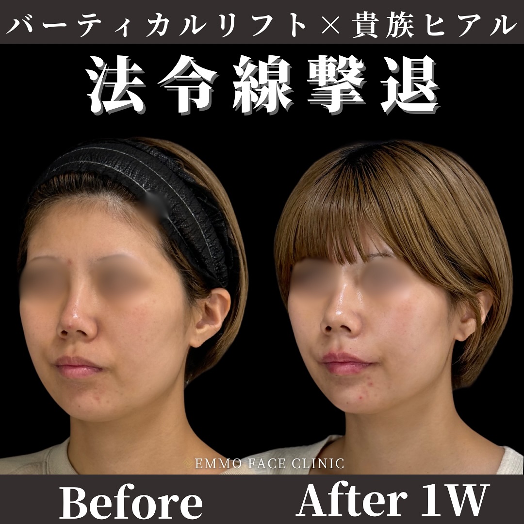 バーティカルリフト