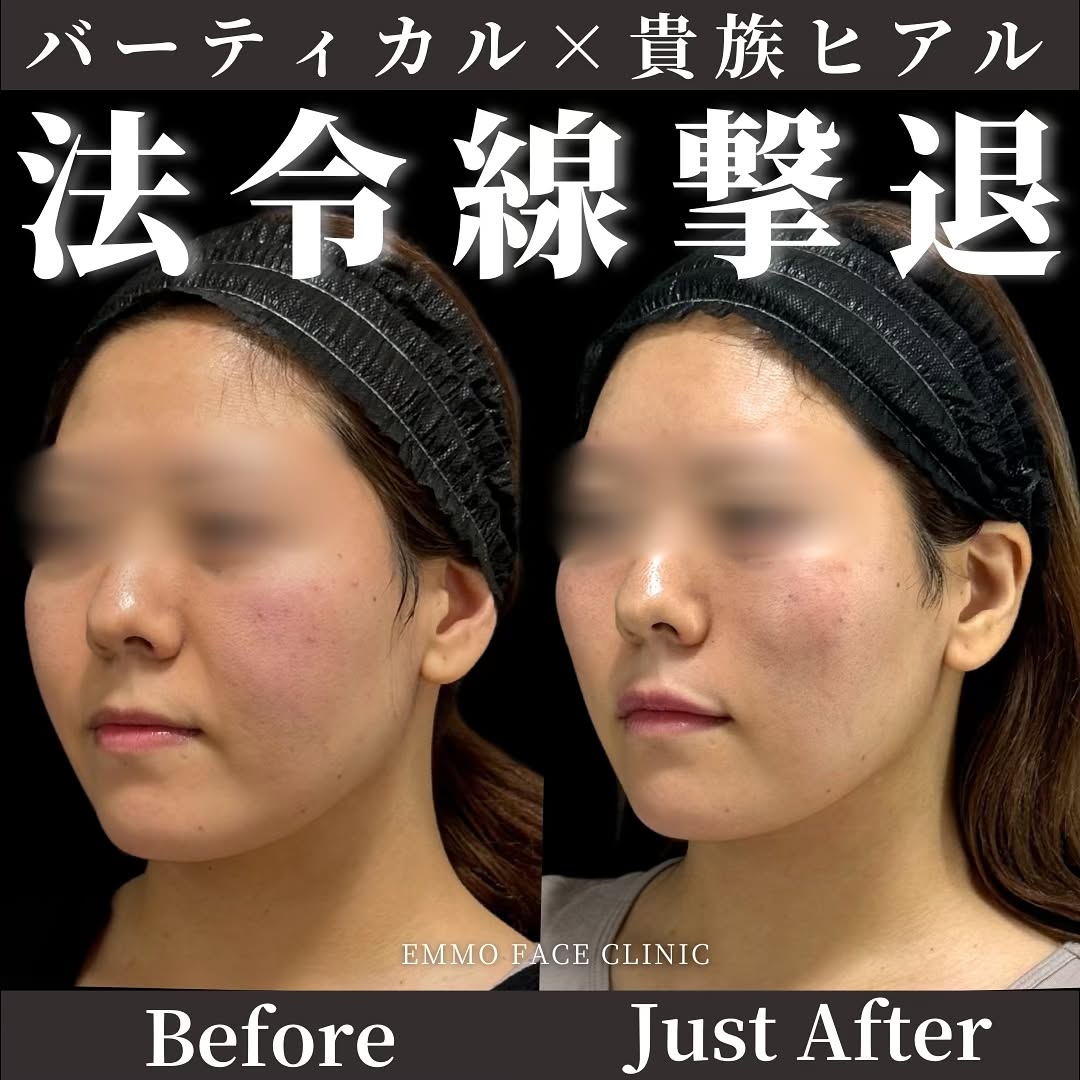 バーティカルリフト