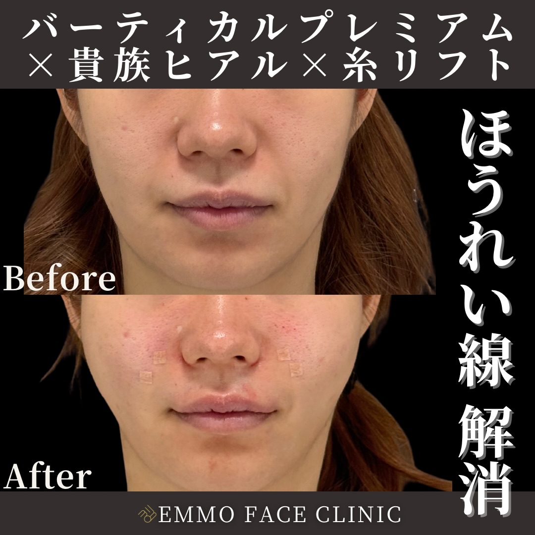 バーティカルリフト