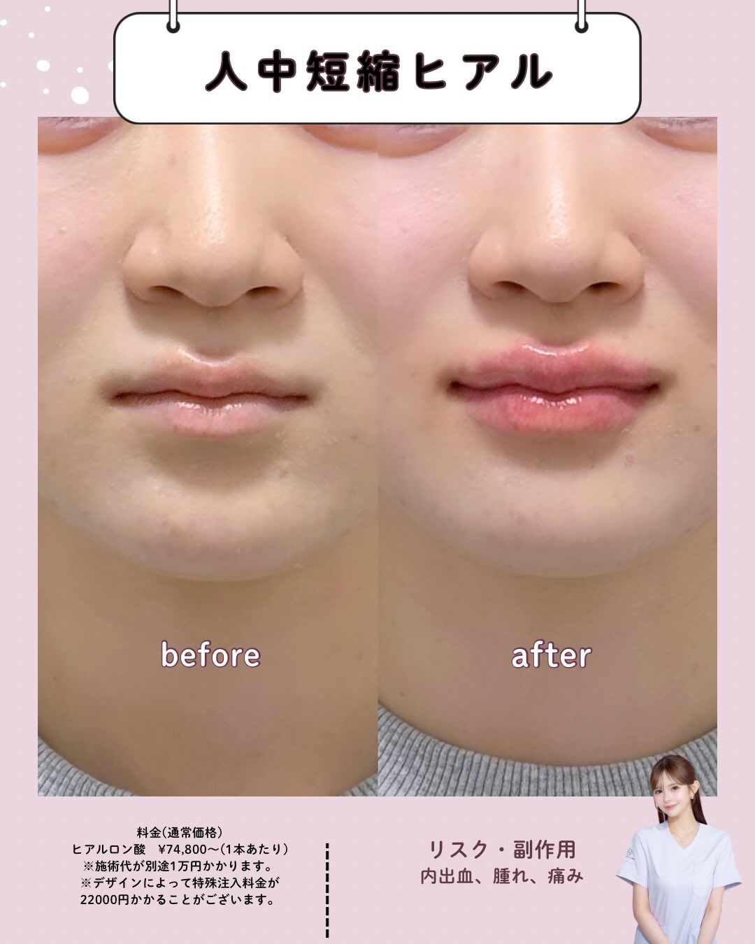 人中短縮ヒアルロン酸