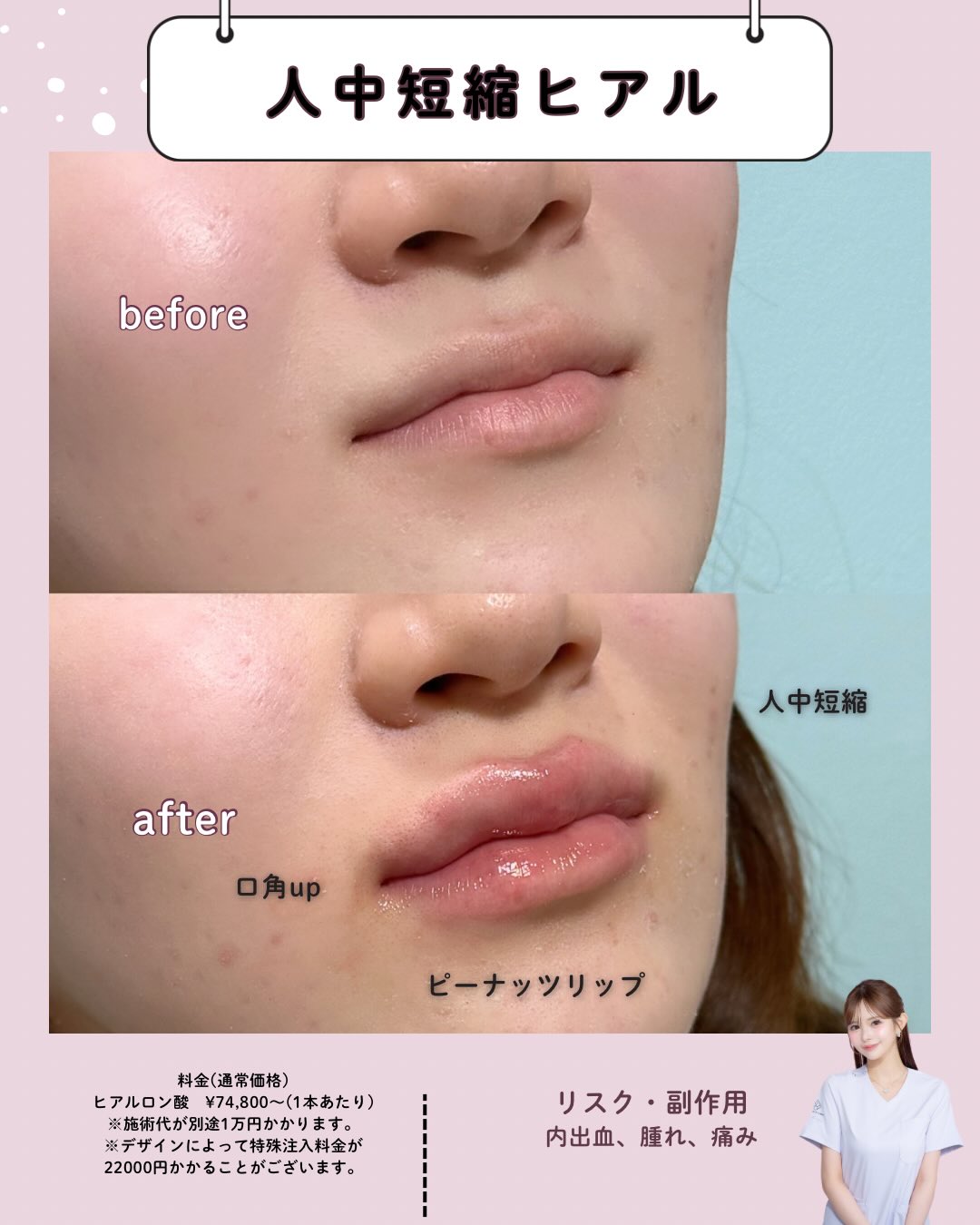 人中短縮ヒアルロン酸