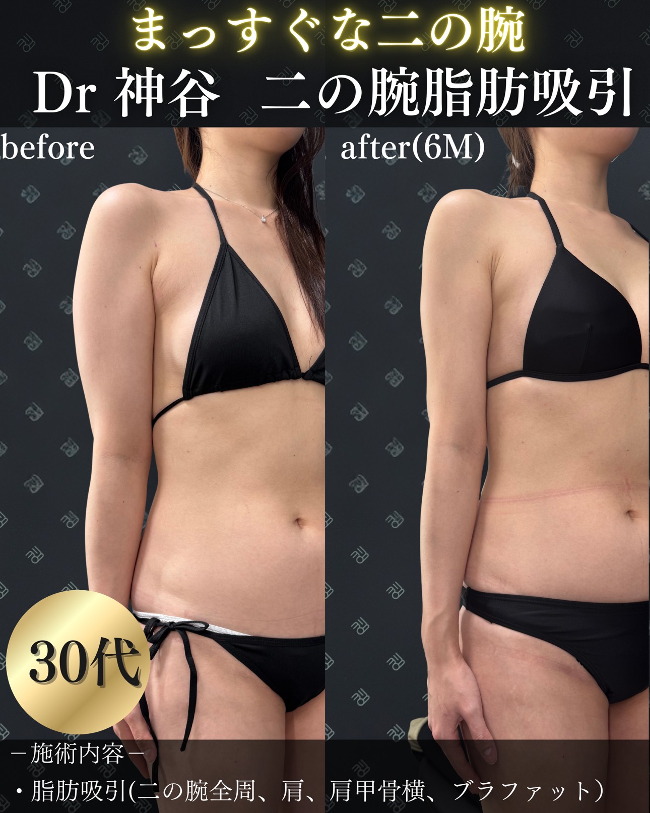 二の腕脂肪吸引