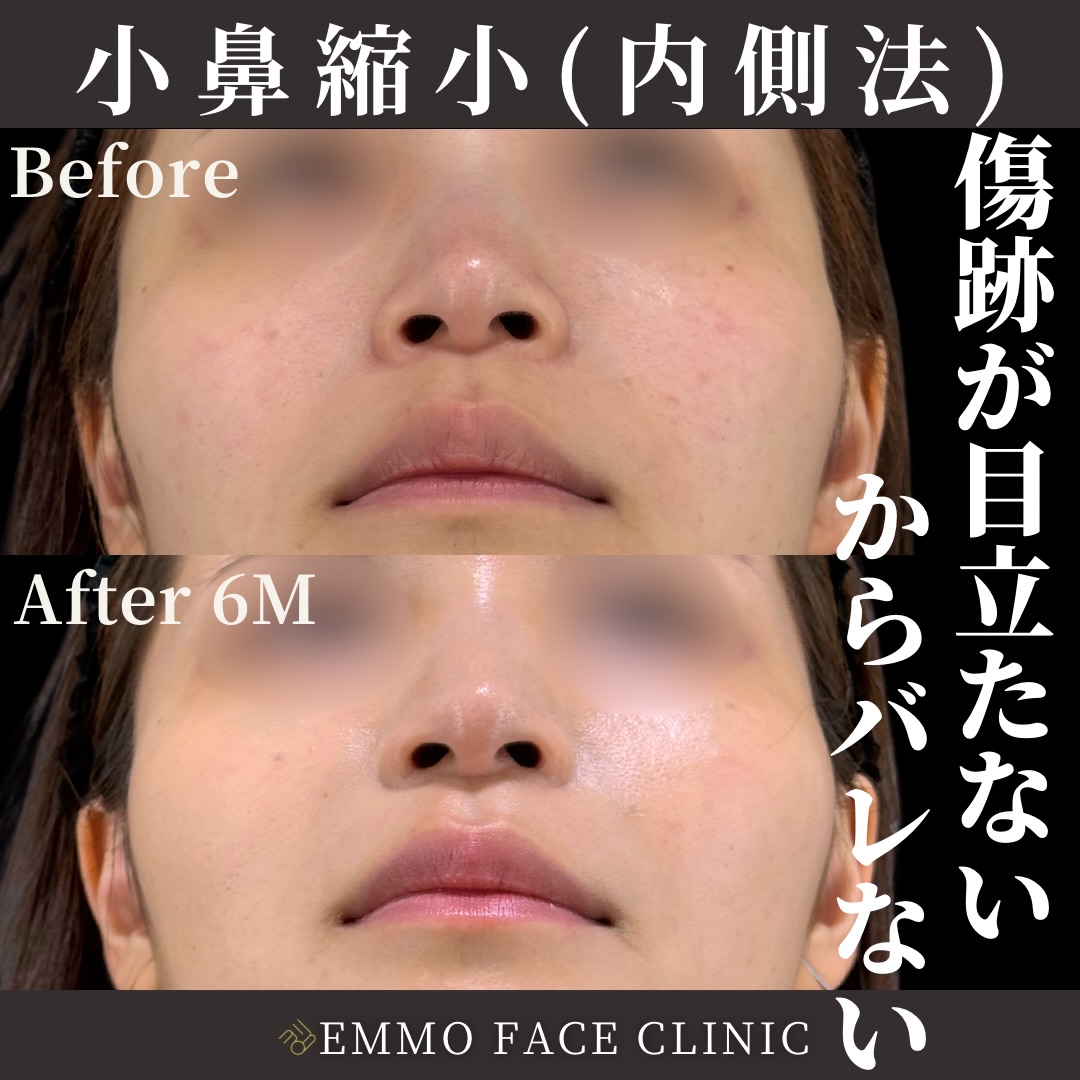 nasal wing reduction