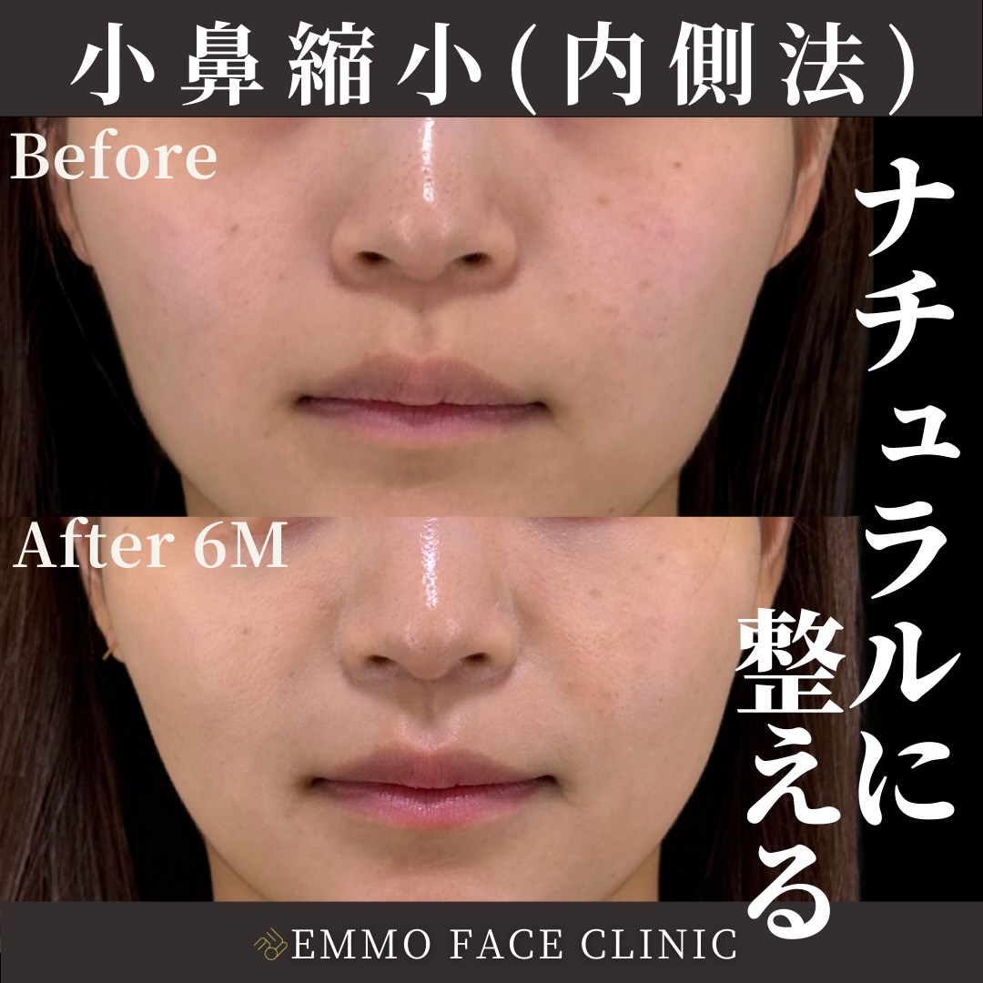 nasal wing reduction