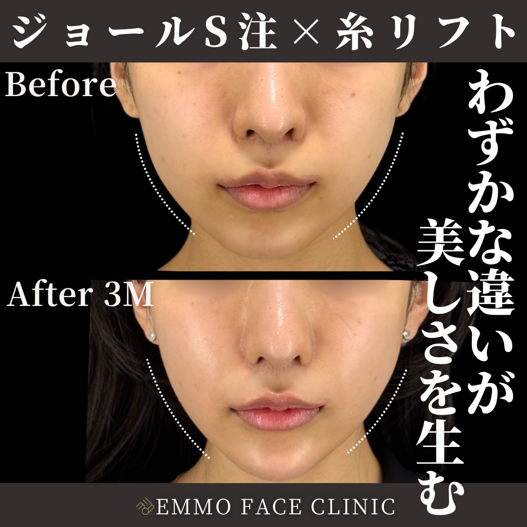 脂肪吸引注射×糸リフト