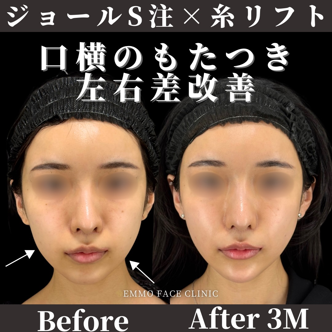 脂肪吸引注射×糸リフト