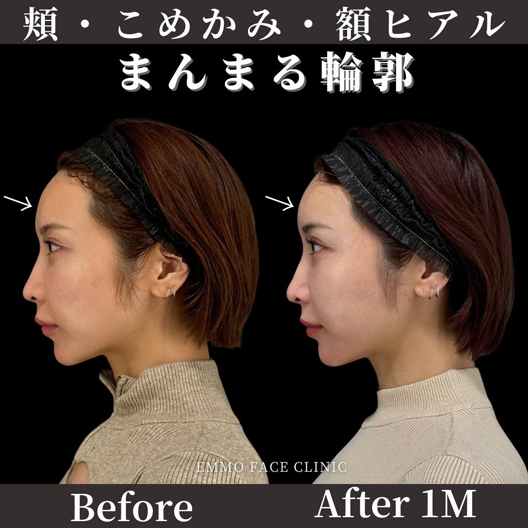 輪郭ヒアルロン酸