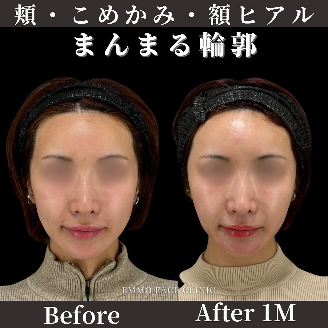 輪郭ヒアルロン酸